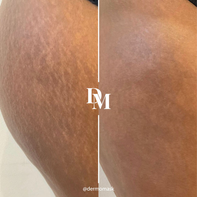 Résultat traitement vergetures cuisses